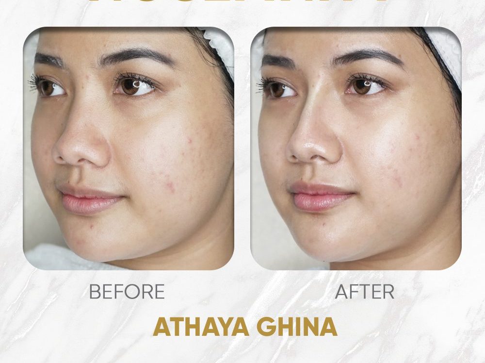 Prosedur Tanam Benang Hidung: Hasil Memukau, Perawatan Mudah, Keamanan Terjamin! Prosedur Tanam Benang Hidung: Hasil Memukau, Perawatan Mudah, Keamanan Terjamin!